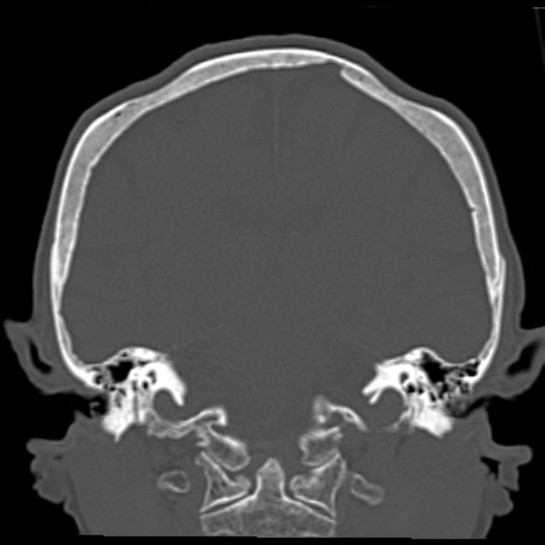 Biparietal osteodystrophy (Radiopaedia 46109-50463 Coronal bone window 63).jpg