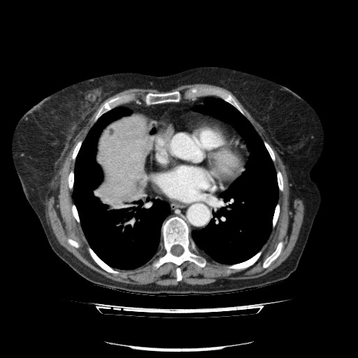 File:Bladder tumor detected on trauma CT (Radiopaedia 51809-57609 B 6).jpg