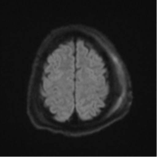 Blunt cerebrovascular injury (Radiopaedia 53682-59745 Axial DWI 55).png