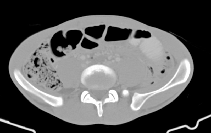 Blunt injury to the small bowel (Radiopaedia 74953-85987 Axial Wide 63).jpg