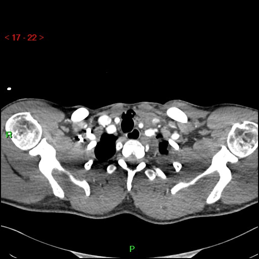 Blunt thoracic trauma (Radiopaedia 73454-84221 Axial soft tissues 9).jpg