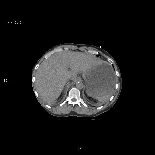 Boerhaave syndrome (Radiopaedia 27683-27897 Axial non-contrast 87).jpg
