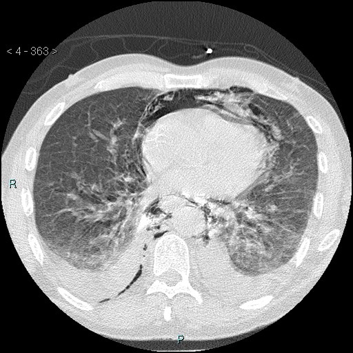 Boerhaave syndrome (Radiopaedia 27683-27897 lung window 63).jpg