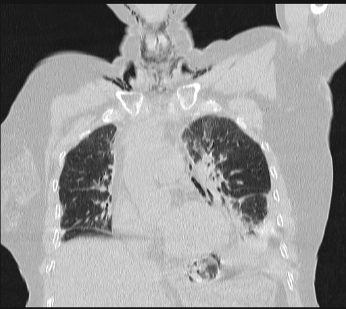Boerhaave syndrome (Radiopaedia 45644-49799 Coronal lung window 26).jpg