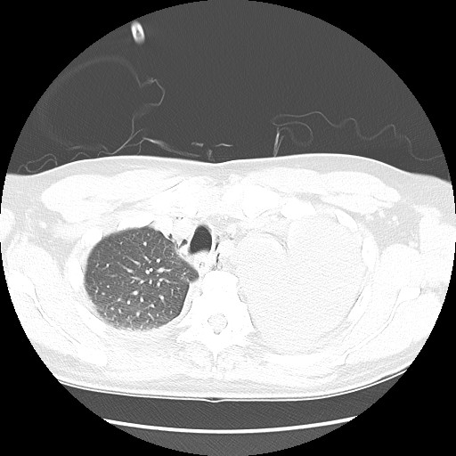 Boerhaave syndrome (Radiopaedia 59796-67310 Axial lung window 16).jpg