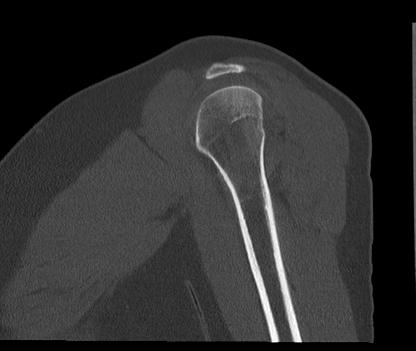 Bony Bankart and Hill-Sachs lesions (Radiopaedia 33622-34727 Sagittal bone window 20).png