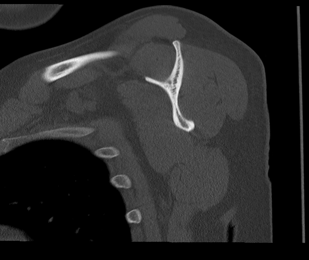 Bony Bankart and Hill-Sachs lesions (Radiopaedia 33622-34727 Sagittal bone window 41).png