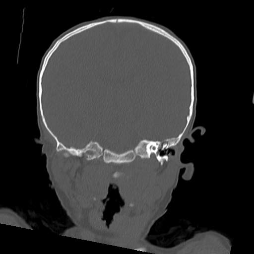 File:Bony atresia of the right external auditory canal (Radiopaedia 27916-28156 Coronal bone window 13).jpg