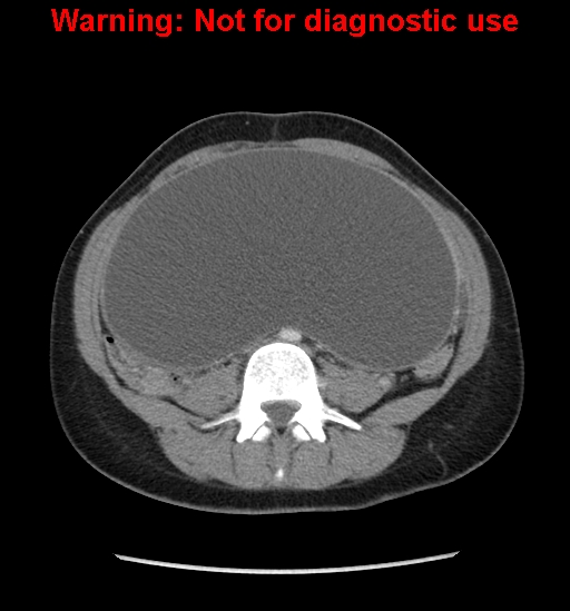 Borderline mucinous cystadenoma of ovary (Radiopaedia 25586-25767 A 43).jpg