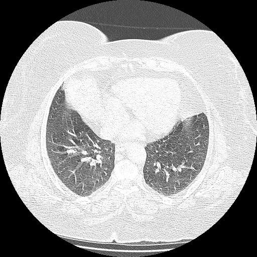 Bovine aortic arch - right internal mammary vein drains into the superior vena cava (Radiopaedia 63296-71875 Axial lung window 111).jpg