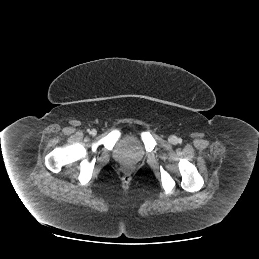 Bowel and splenic infarcts in acute lymphocytic leukemia (Radiopaedia 61055-68915 A 127).jpg