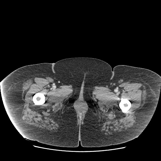 Bowel and splenic infarcts in acute lymphocytic leukemia (Radiopaedia 61055-68915 A 140).jpg