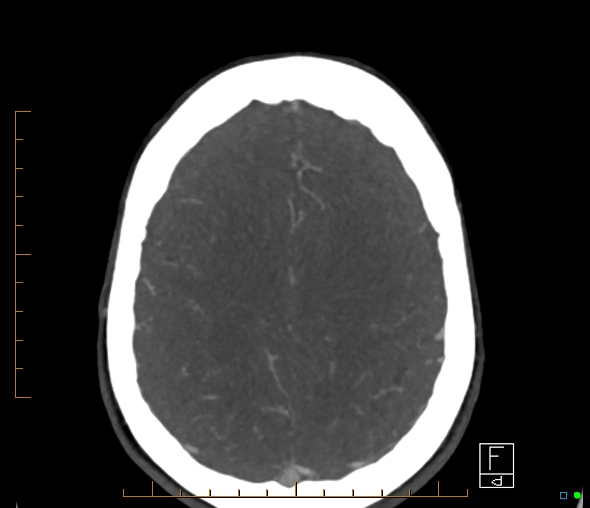 Brachiocephalic trunk stenosis (Radiopaedia 87242-103519 A 18).jpg