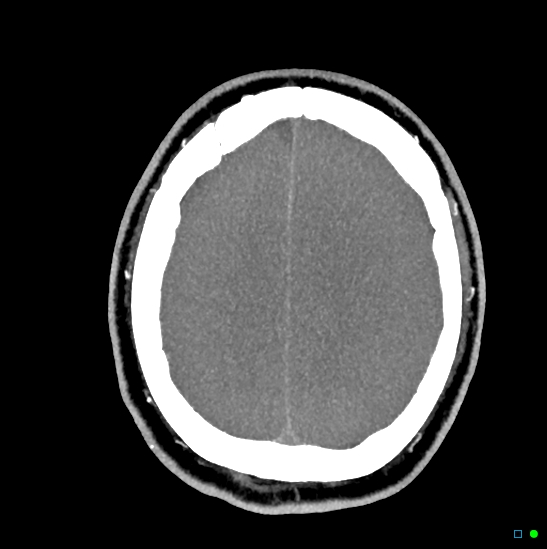 Brain death on MRI and CT angiography (Radiopaedia 42560-45841 B 14).jpg