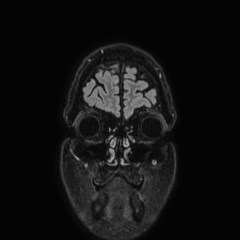 Brain metastases from lung cancer (Radiopaedia 83839-99028 Coronal FLAIR 4).jpg