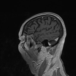 Brain metastasis (Radiopaedia 42617-45761 Sagittal T1 C+ 81).jpg