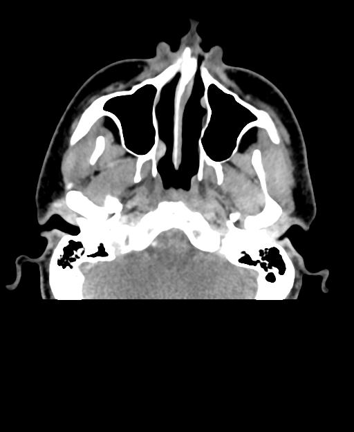 Branchial cleft cyst (Radiopaedia 31167-31875 Axial C+ delayed 3).jpg