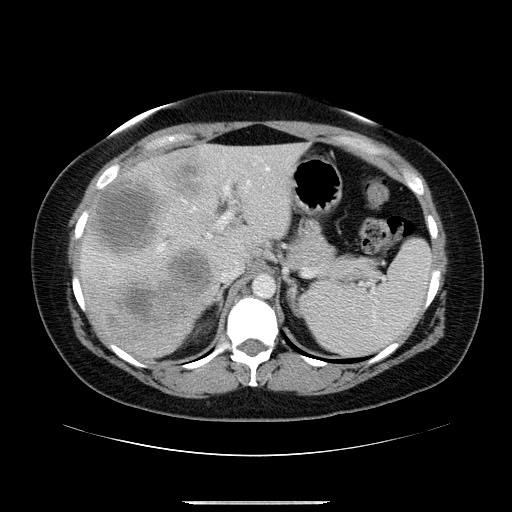 File:Breast cancer pseudocirrhosis after chemotherapy (Radiopaedia 65407-74456 A 23).jpg
