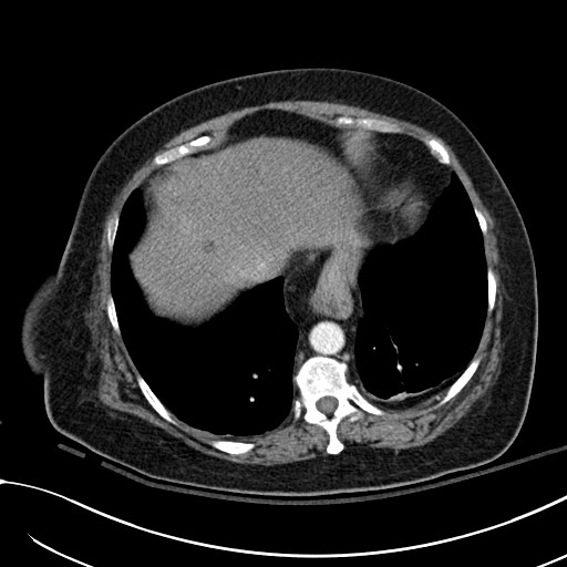 Breast carcinoma with pathological hip fracture (Radiopaedia 60314-67974 A 43).jpg