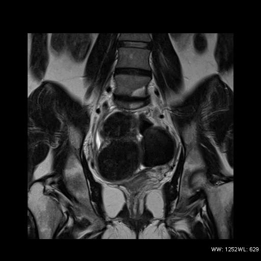 File:Broad ligament fibroid (Radiopaedia 49135-54241 Coronal T2 16).jpg