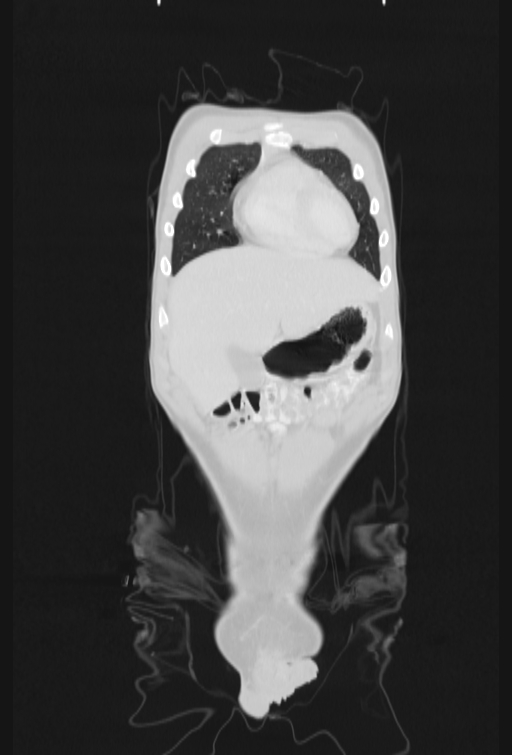 Bronchial carcinoid tumor (Radiopaedia 57187-64090 Coronal lung window 11).jpg