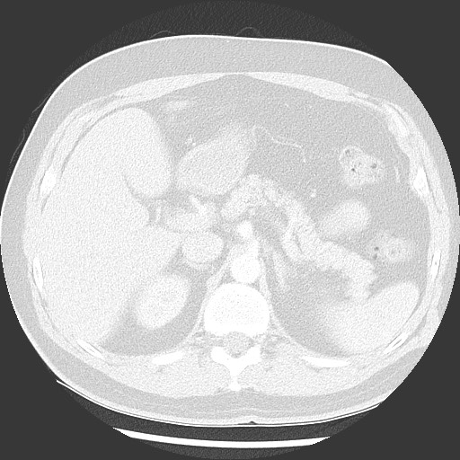 Bronchial carcinoid tumor (Radiopaedia 67377-76764 Axial lung window 64).jpg