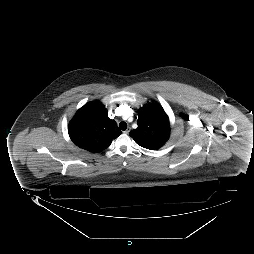 File:Bronchial carcinoid tumor (Radiopaedia 78272-90870 B 32).jpg