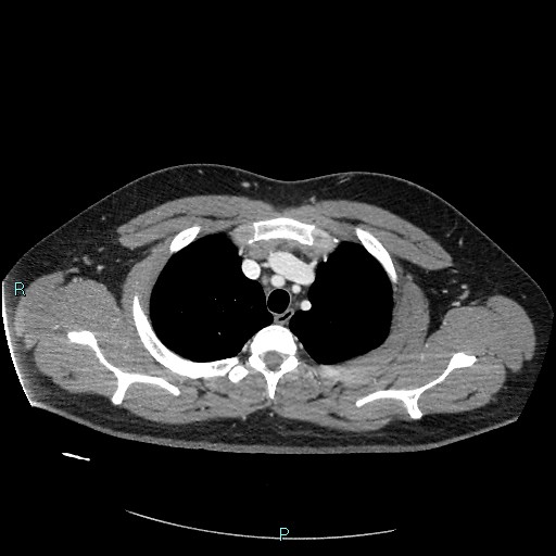 Bronchial carcinoid tumor (Radiopaedia 78272-90875 A 25).jpg
