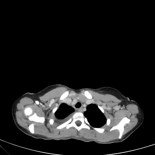 Bronchial mucoepidermoid carcinoma (Radiopaedia 57023-63895 Axial 16).jpg