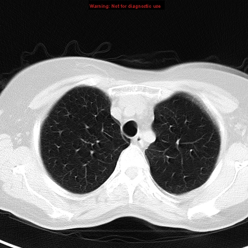 File:Bronchoalveolar carcinoma (BAC) (Radiopaedia 13436-13392 Axial lung window 11).jpg