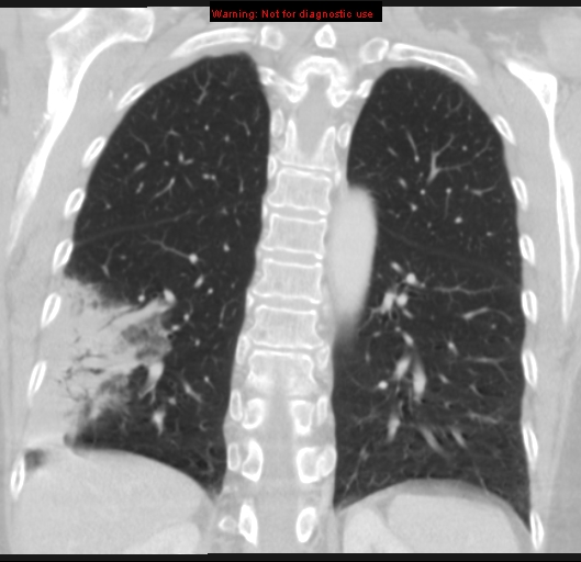 Bronchoalveolar carcinoma (BAC) (Radiopaedia 13436-13392 Coronal lung window 42).jpg