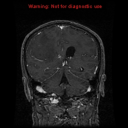 File:Bronchogenic carcinoma brain metastasis (Radiopaedia 9286-9969 Coronal T1 5).jpg
