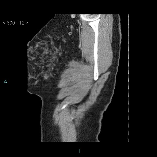 Bronchogenic cyst - posterior mediastinal (Radiopaedia 43885-47364 B 7).jpg