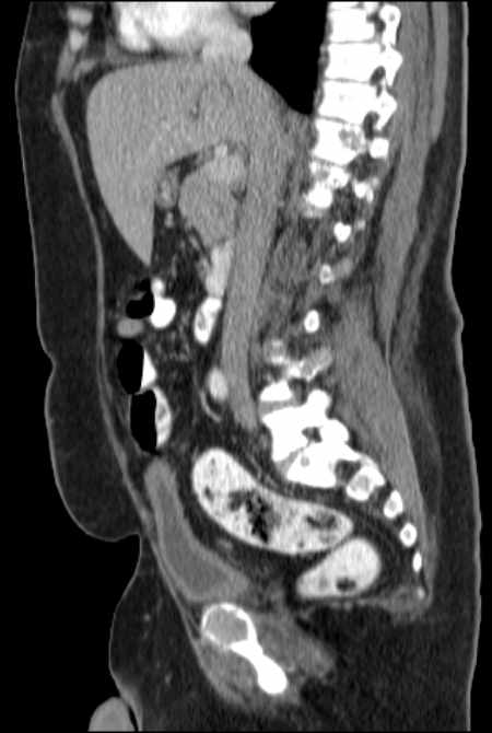 Brown tumors compressing the spinal cord (Radiopaedia 68442-77988 F 26).jpg