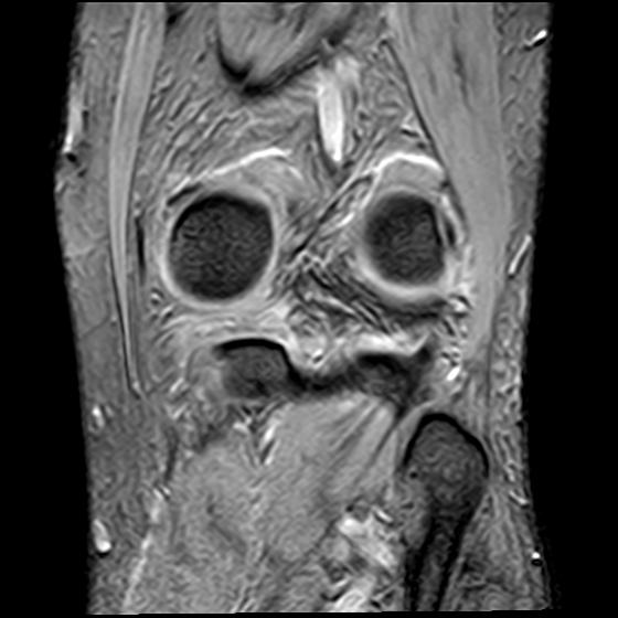 File:Bucket handle tear - medial meniscus (Radiopaedia 29250-29664 B 17).jpg