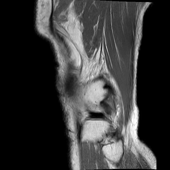 File:Bucket handle tear - medial meniscus (Radiopaedia 29250-29664 Sagittal PD 2).jpg