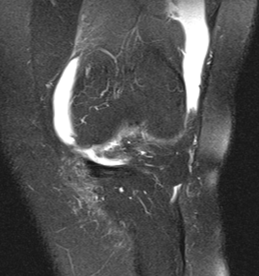 File:Bucket handle tear - medial meniscus (Radiopaedia 79028-91942 Coronal PD fat sat 17).jpg