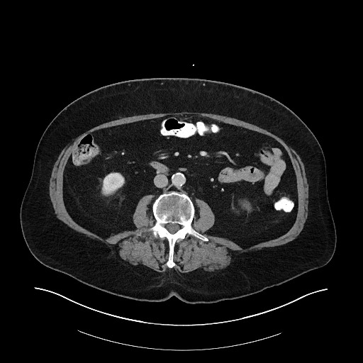 File:Buried bumper syndrome - gastrostomy tube (Radiopaedia 63843-72575 Axial 30).jpg