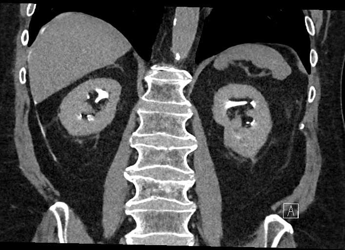 Buried bumper syndrome - gastrostomy tube (Radiopaedia 63843-72577 Coronal Inject 91).jpg
