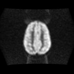 File:Burkitt lymphoma of the orbit- pre and post chemotherapy (Radiopaedia 31214-31930 Axial DWI 13).jpg