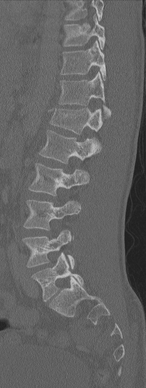 Burst fracture - T12 with conus compression (Radiopaedia 56825-63647 Sagittal bone window 31).png