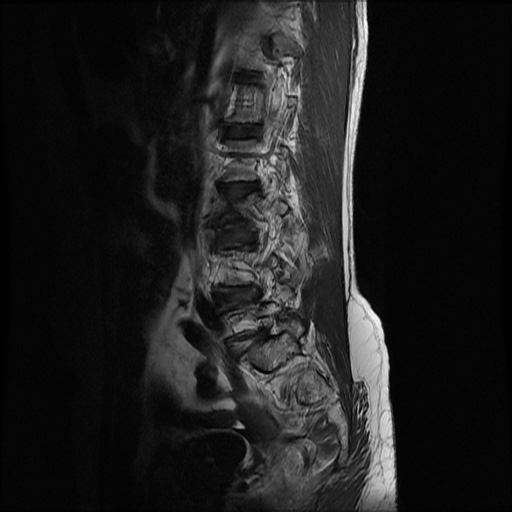 File:Burst fracture - lumbar spine (Radiopaedia 72877-83541 Sagittal T2 1).jpg