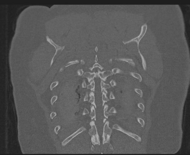 Burst fracture - thoracic spine (Radiopaedia 30238-30865 Coronal bone window 140).jpg