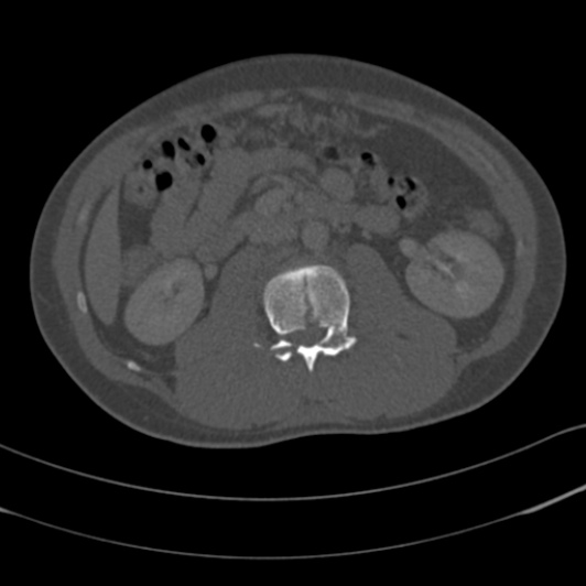 Burst fracture with cauda equina syndrome (Radiopaedia 25701-25867 Axial bone window 52).jpg