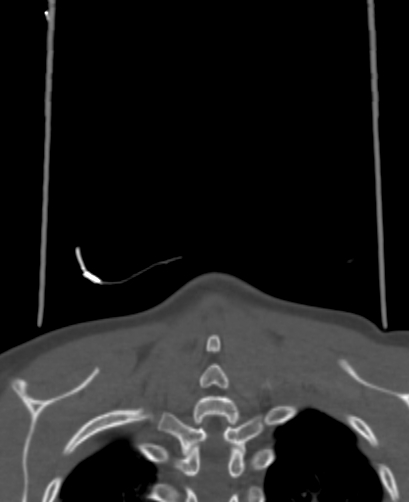 Butterfly vertebra (Radiopaedia 77903-90209 Coronal bone window 107).jpg