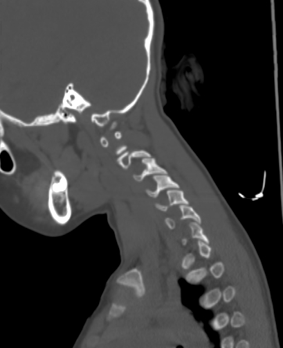 File:Butterfly vertebra (Radiopaedia 77903-90209 Sagittal bone window 93).jpg