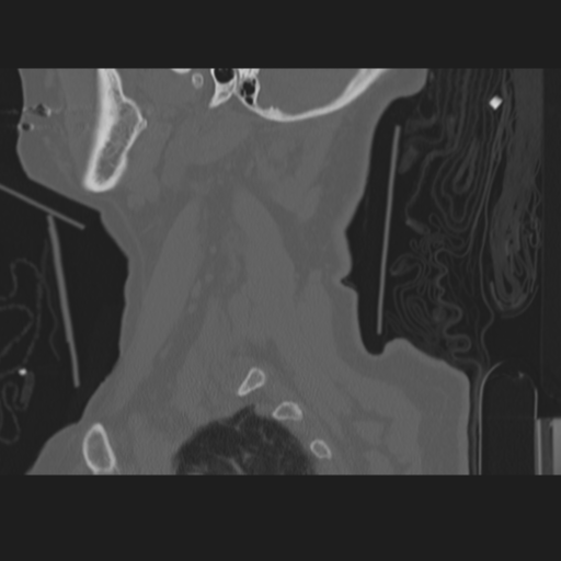 C2 fracture (Radiopaedia 34091-35341 Sagittal bone window 10).png