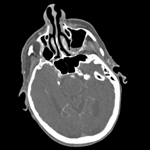 C2 fracture with vertebral artery dissection (Radiopaedia 37378-39200 A 224).png