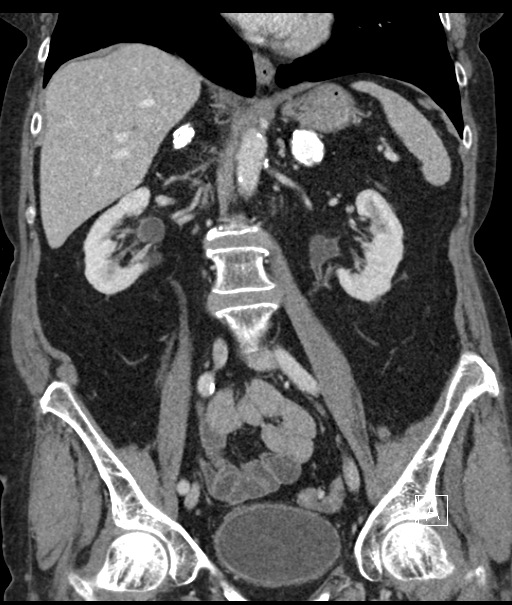 Calcified adrenal glands and Spigelian hernia (Radiopaedia 49741-54988 B 61).jpg