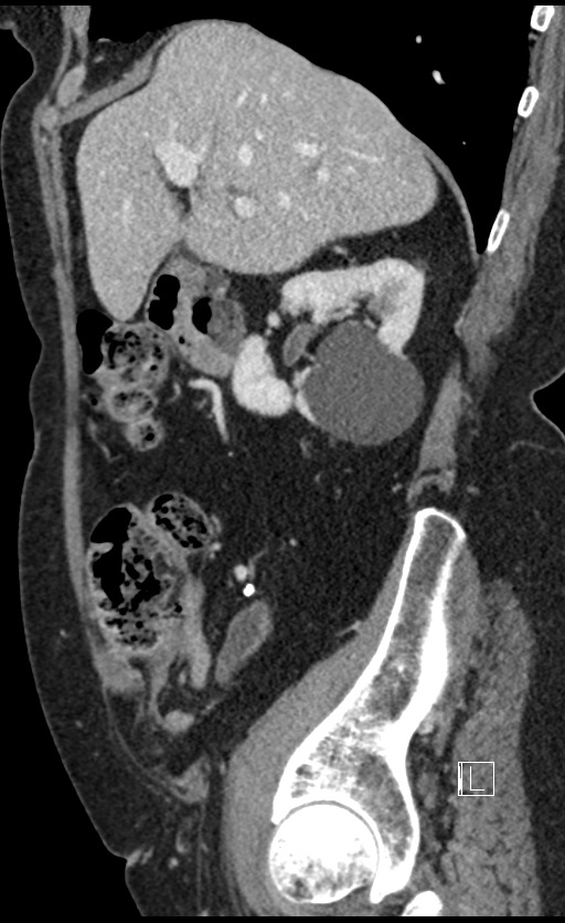 Calcified adrenal glands and Spigelian hernia (Radiopaedia 49741-54988 C 116).jpg